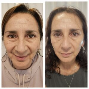 Hifu 22D Facial
